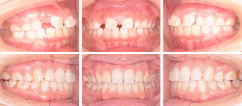 子どものすきっ歯(空隙歯列)の矯正治療例