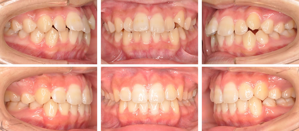 八重歯・叢生の矯正治療例
