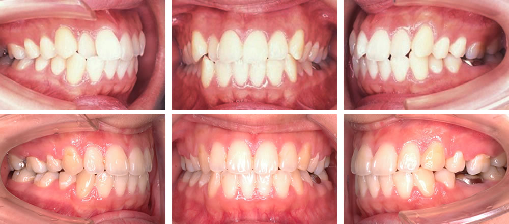 八重歯・叢生の矯正治療例